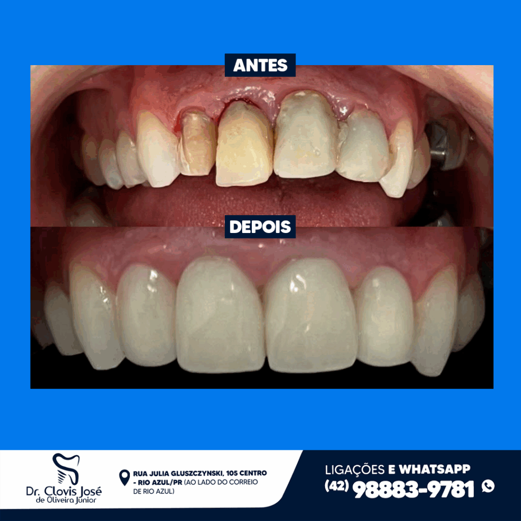 ANTESXDEPOIS-CLOVIS