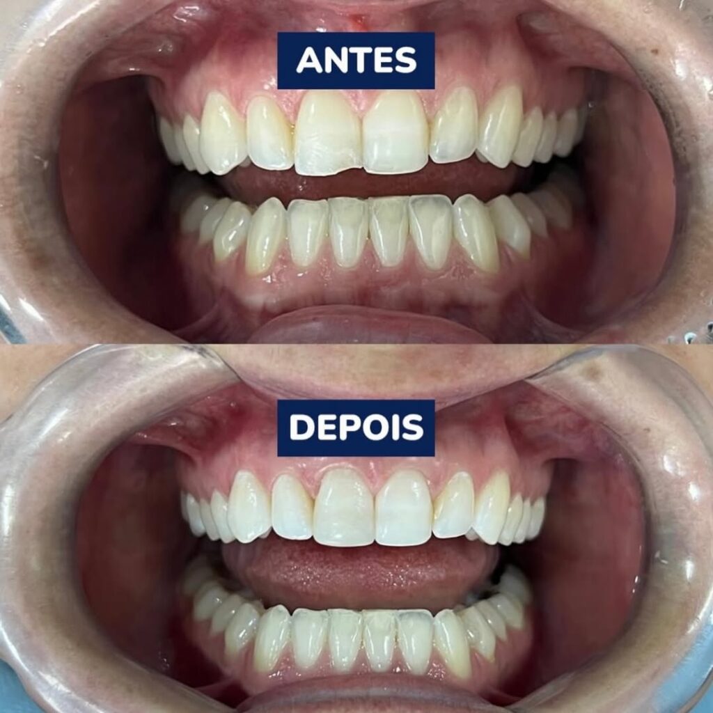 O poder das restaurações em resina composta e a transformação de sorrisos!! Nesse caso dente anterior fraturado que foi restaurado com Resina importada! Devolvendo naturalidade, anat